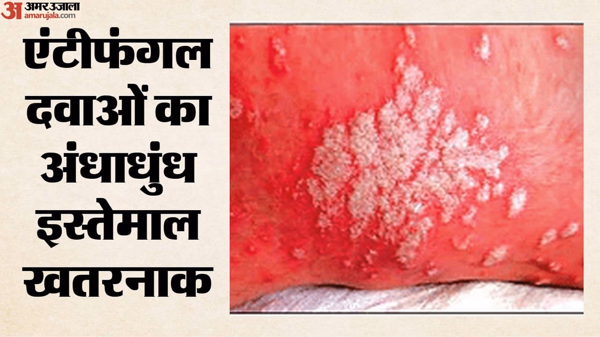 Fungal Infection: हर साल 30 करोड़ लोग हो रहे फंगल संक्रमण का शिकार, डब्ल्यूएचओ ने जारी की वैश्विक रणनीति